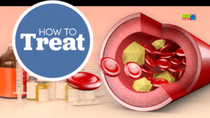 High cholesterol will be cured for life!